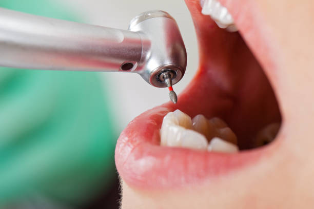 Best Emergency Tooth Extraction in Hamlet, NC